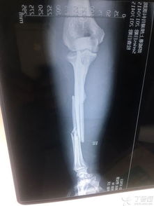 尺桡开放骨折的功能重建与修复策略 结合医学伦理与临床特征的解析
